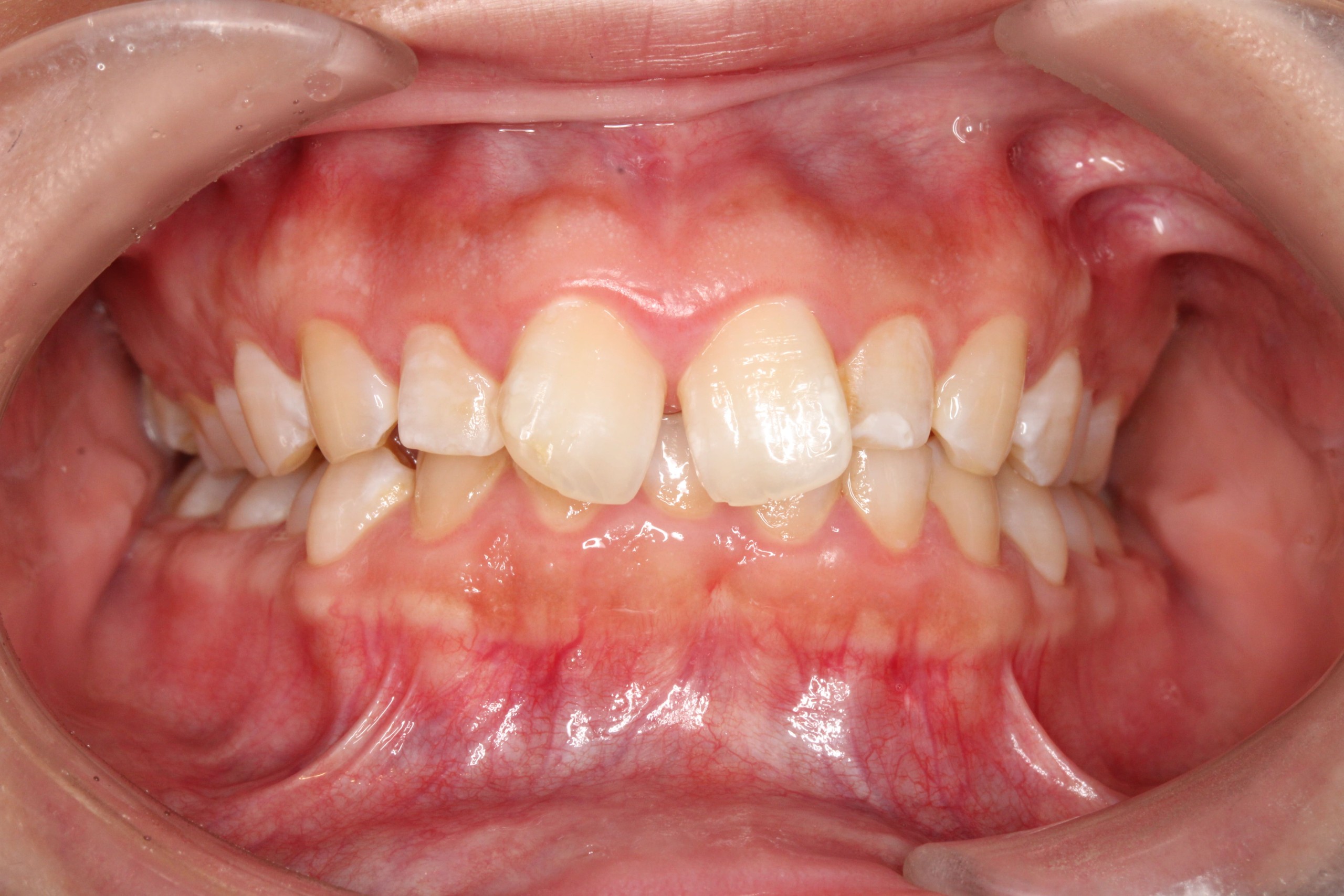 過蓋咬合の症例（初診）