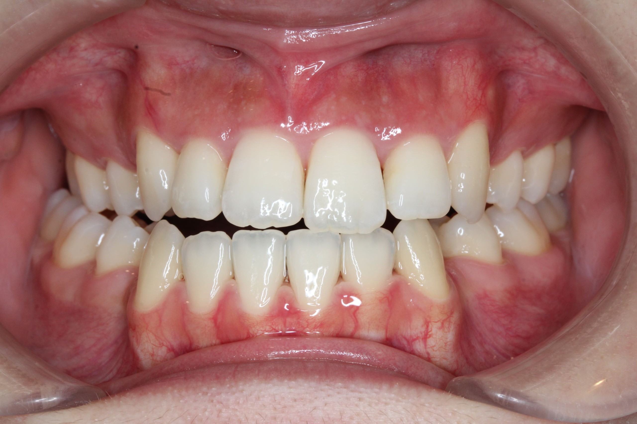 裏側矯正　叢生・下顎前突症例