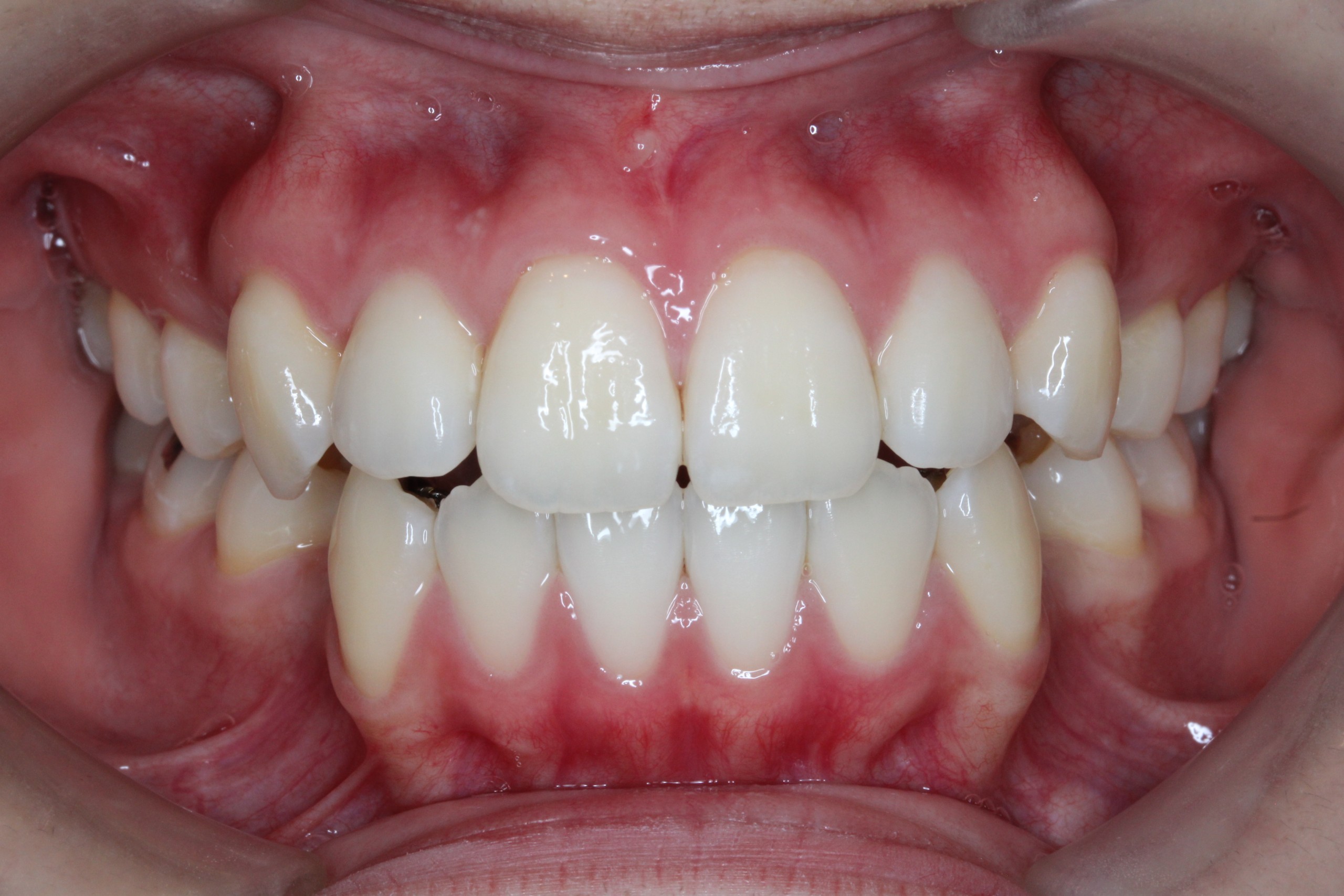 叢生・裏側矯正の症例