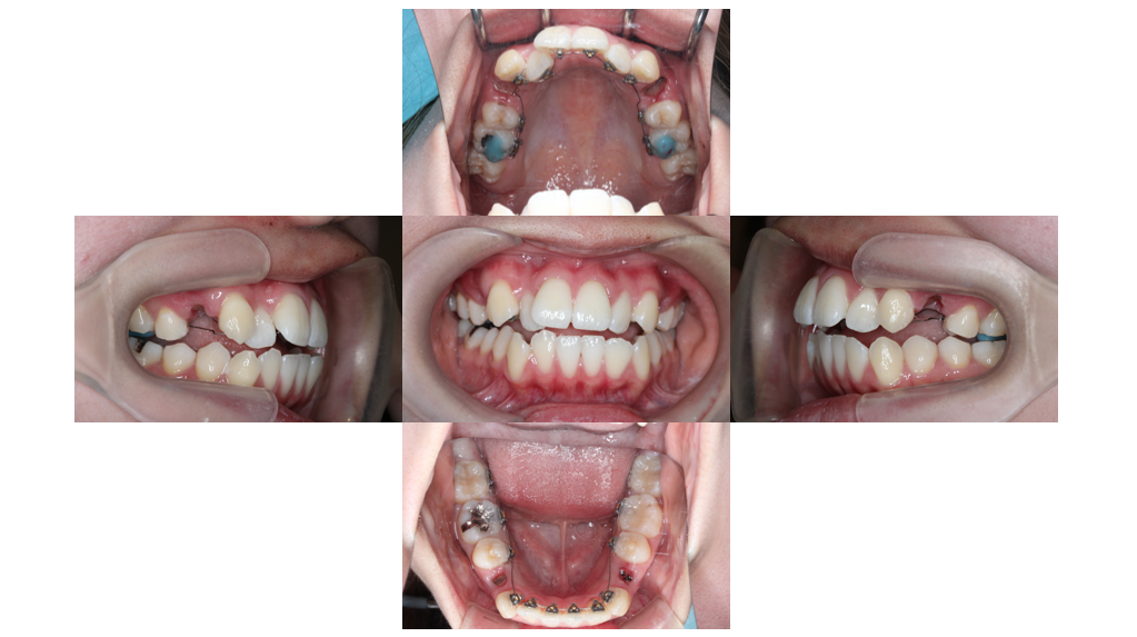叢生・裏側矯正の症例