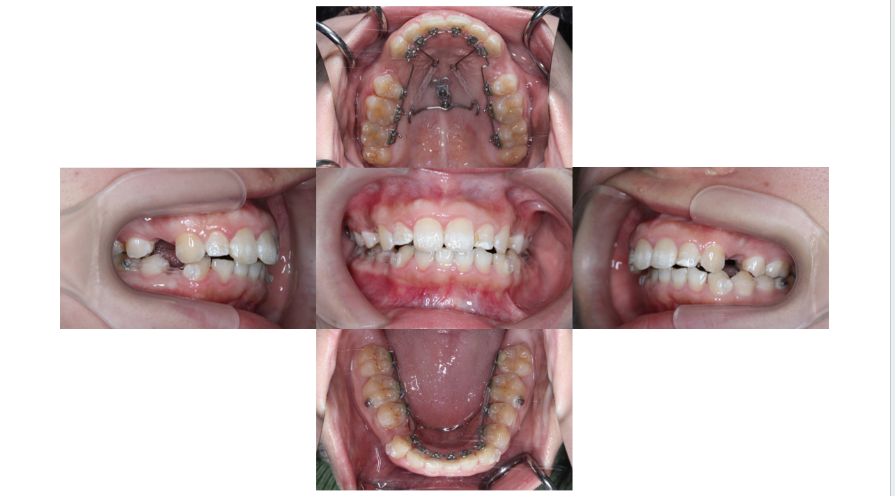 裏側矯正・過蓋咬合の症例　12ヶ月経過