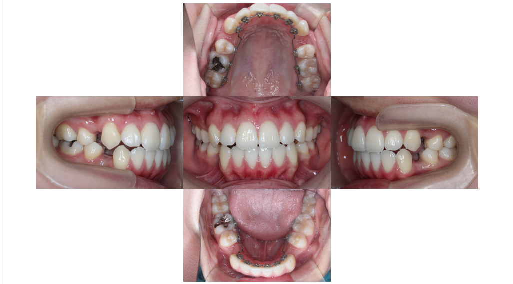 叢生・裏側矯正の症例