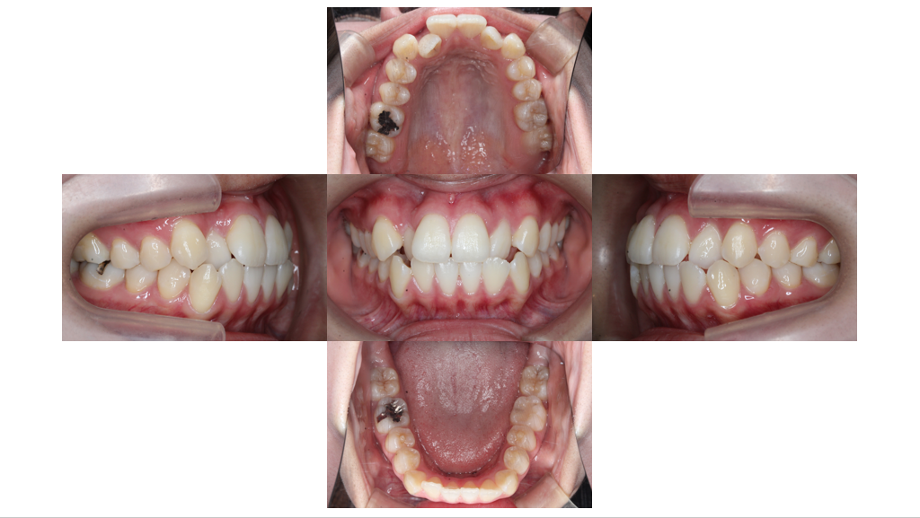 叢生・裏側矯正の症例