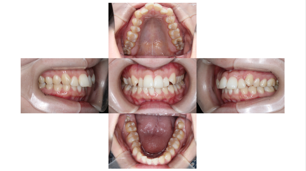 裏側矯正・叢生の症例
