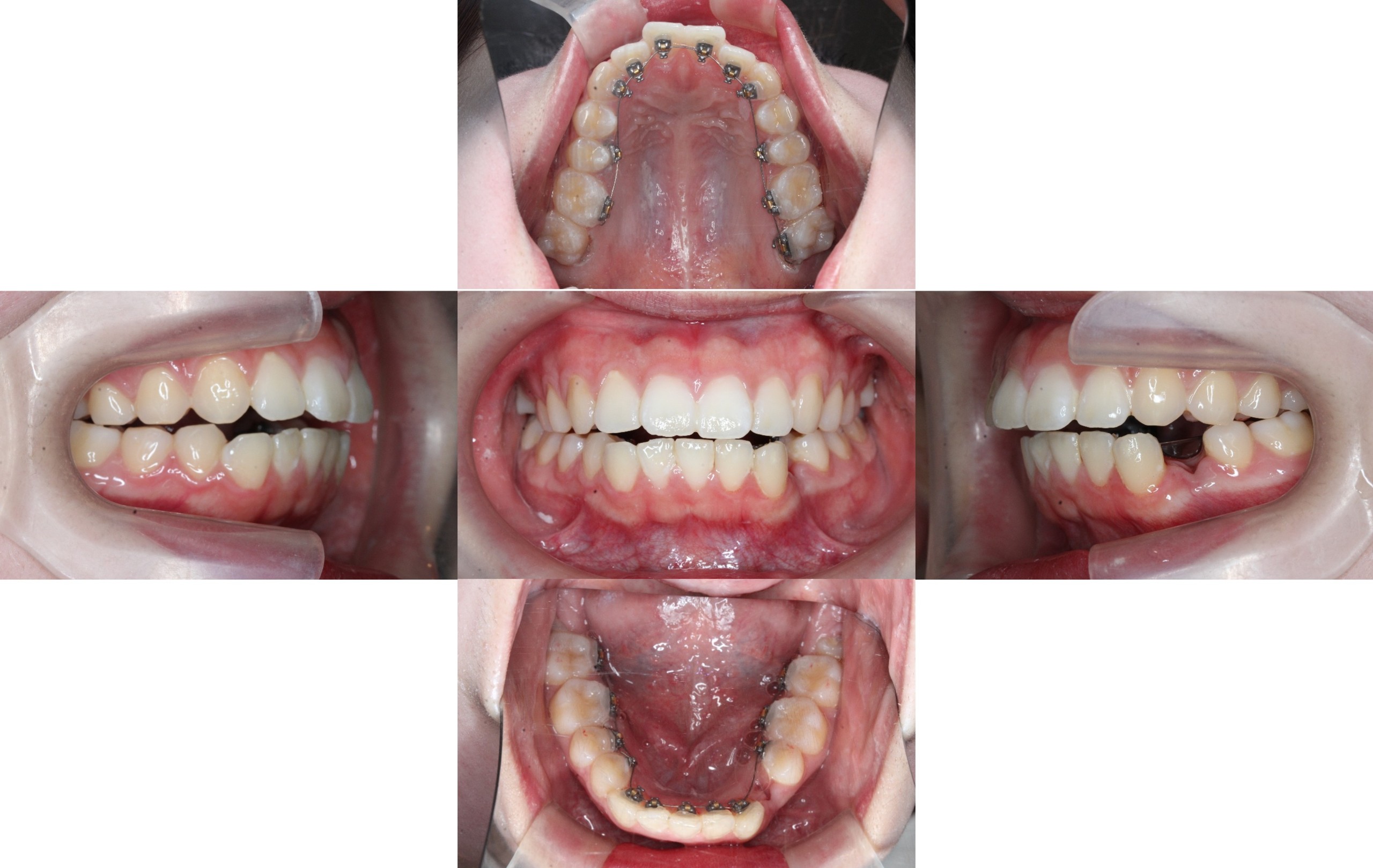 裏側矯正　上顎前突　開咬症例