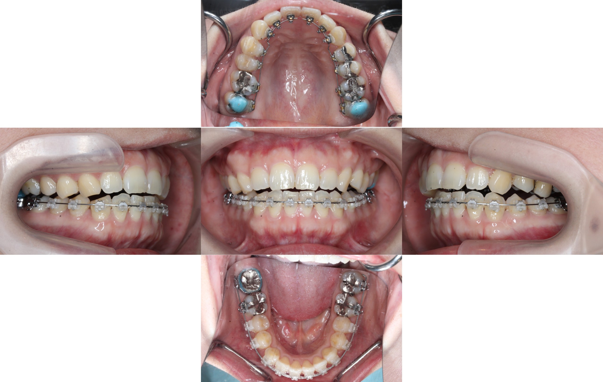 ハーフリンガル矯正　叢生症例