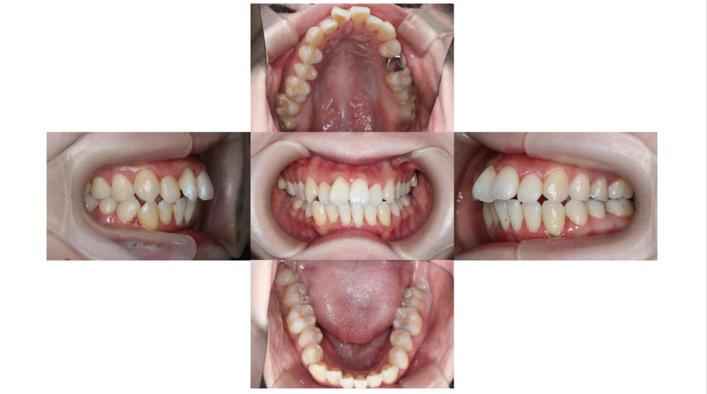 叢生・裏側全体矯正の症例