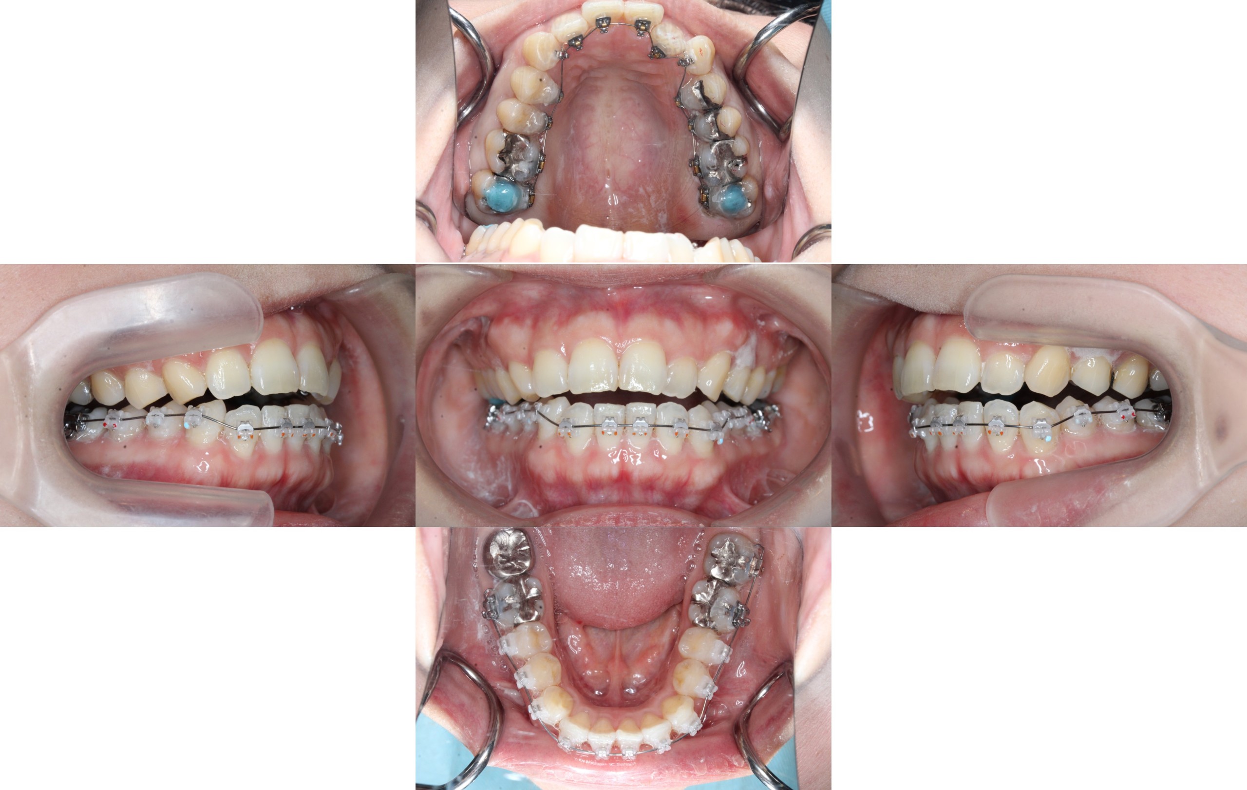 ハーフリンガル矯正　叢生症例