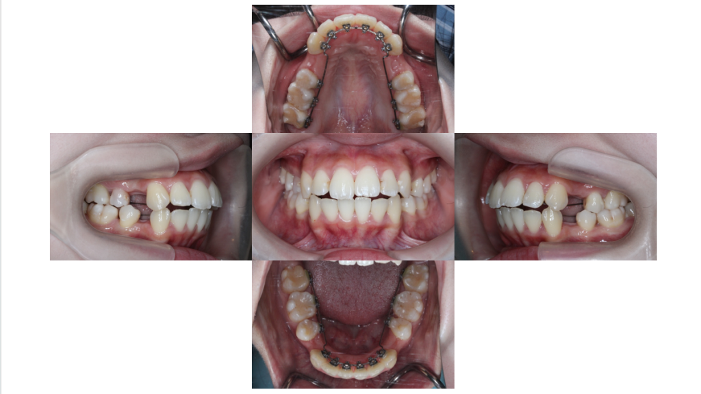 叢生・裏側矯正の症例