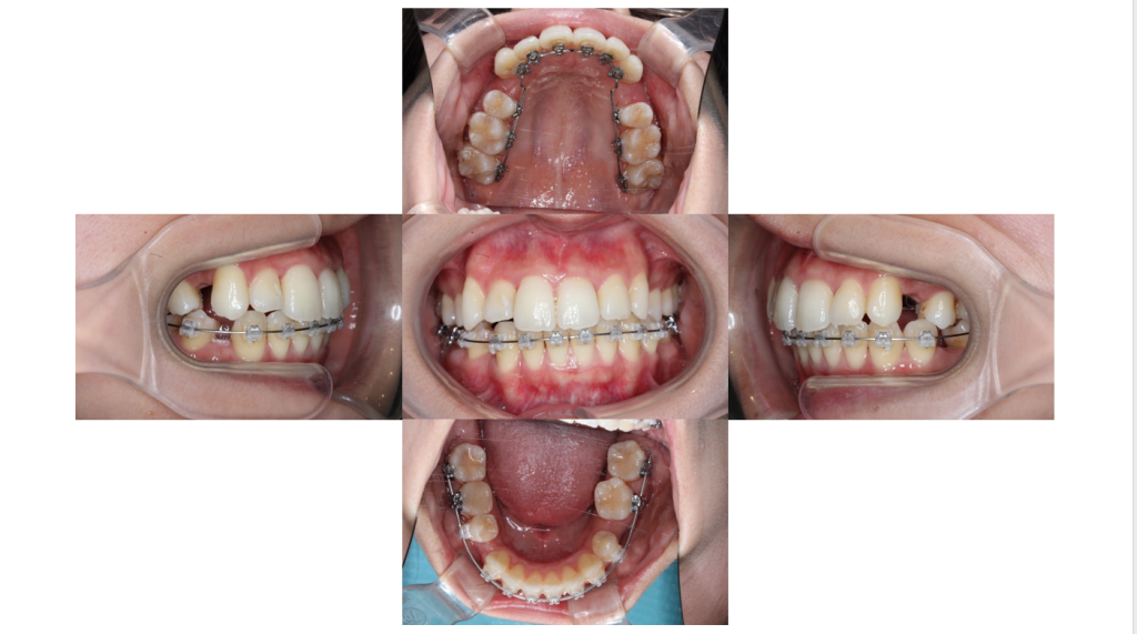 叢生・ハーフリンガルの症例