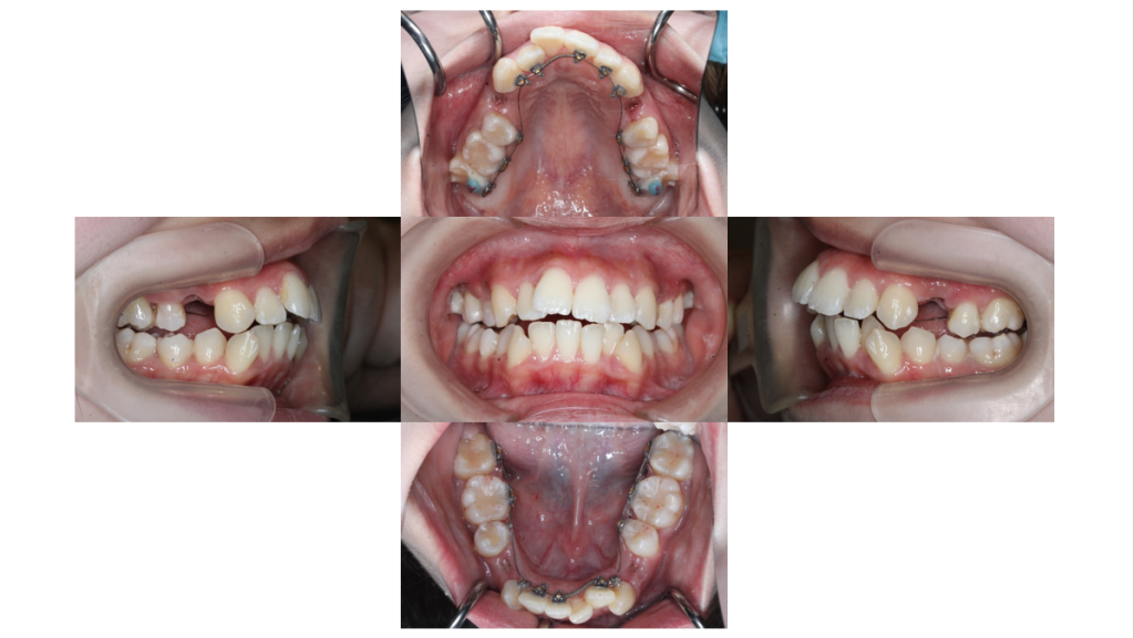 叢生・裏側矯正の症例