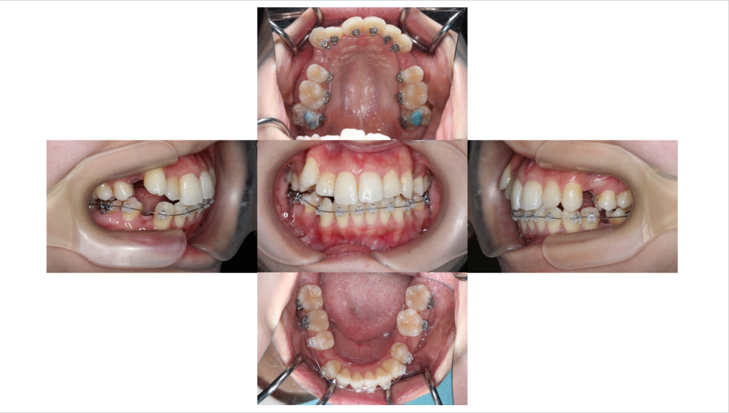 叢生・ハーフリンガルの症例