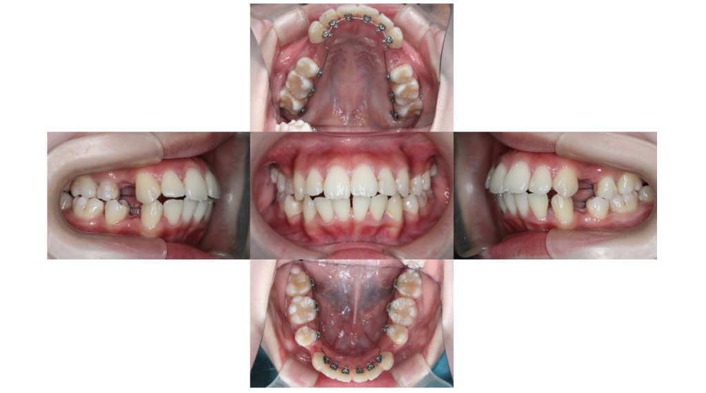 叢生・裏側矯正の症例