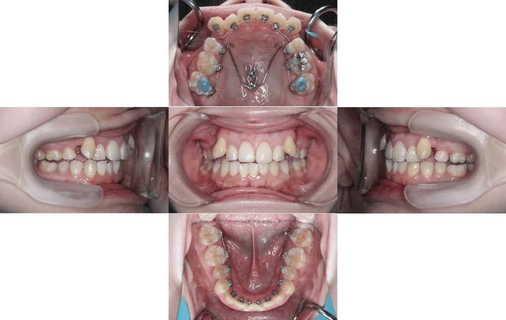 裏側矯正　叢生症例