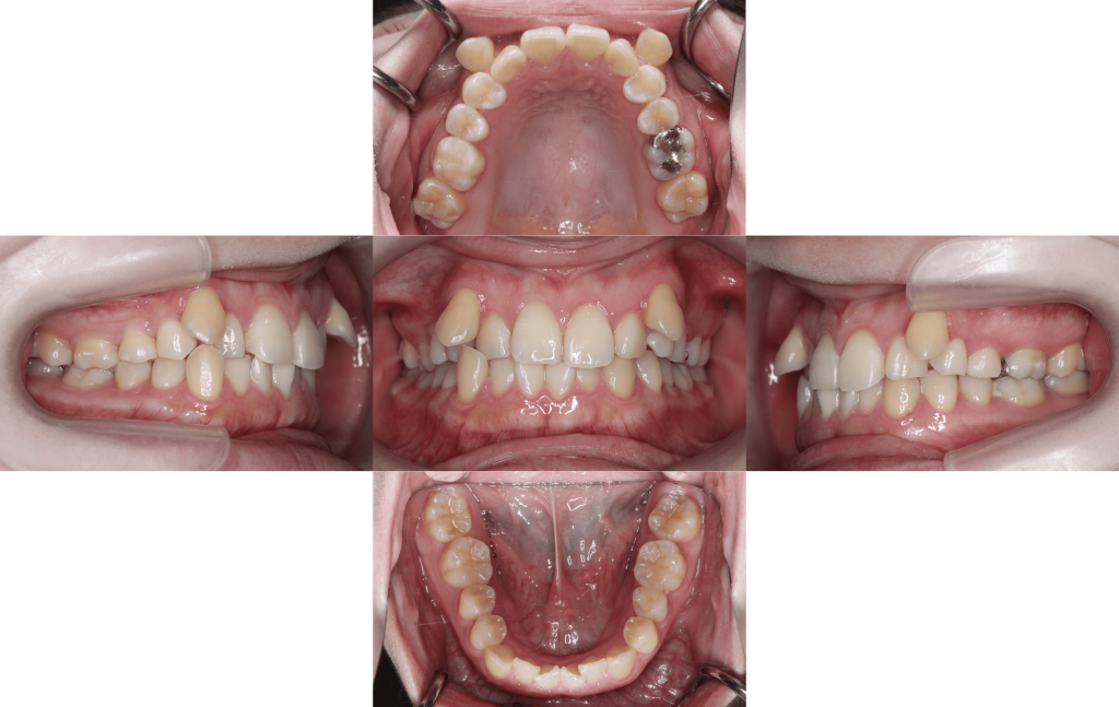 裏側矯正　叢生症例
