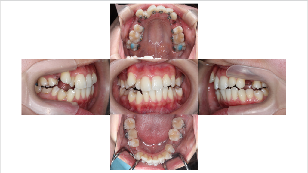 叢生・ハーフリンガルの症例