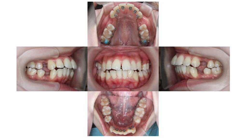 叢生・裏側矯正の症例