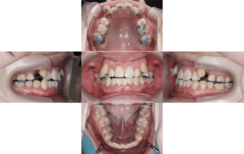 裏側矯正　叢生症例