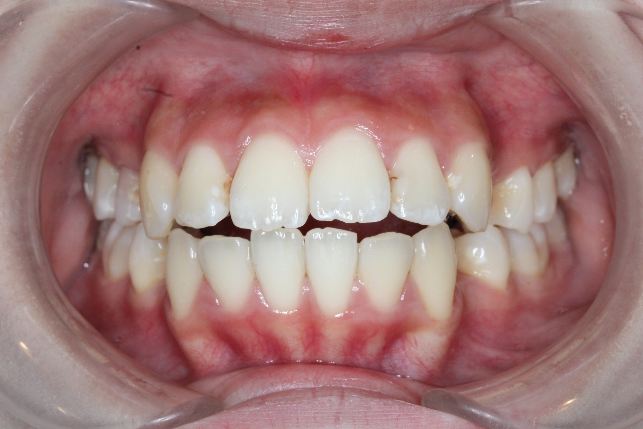 叢生・裏側矯正の症例