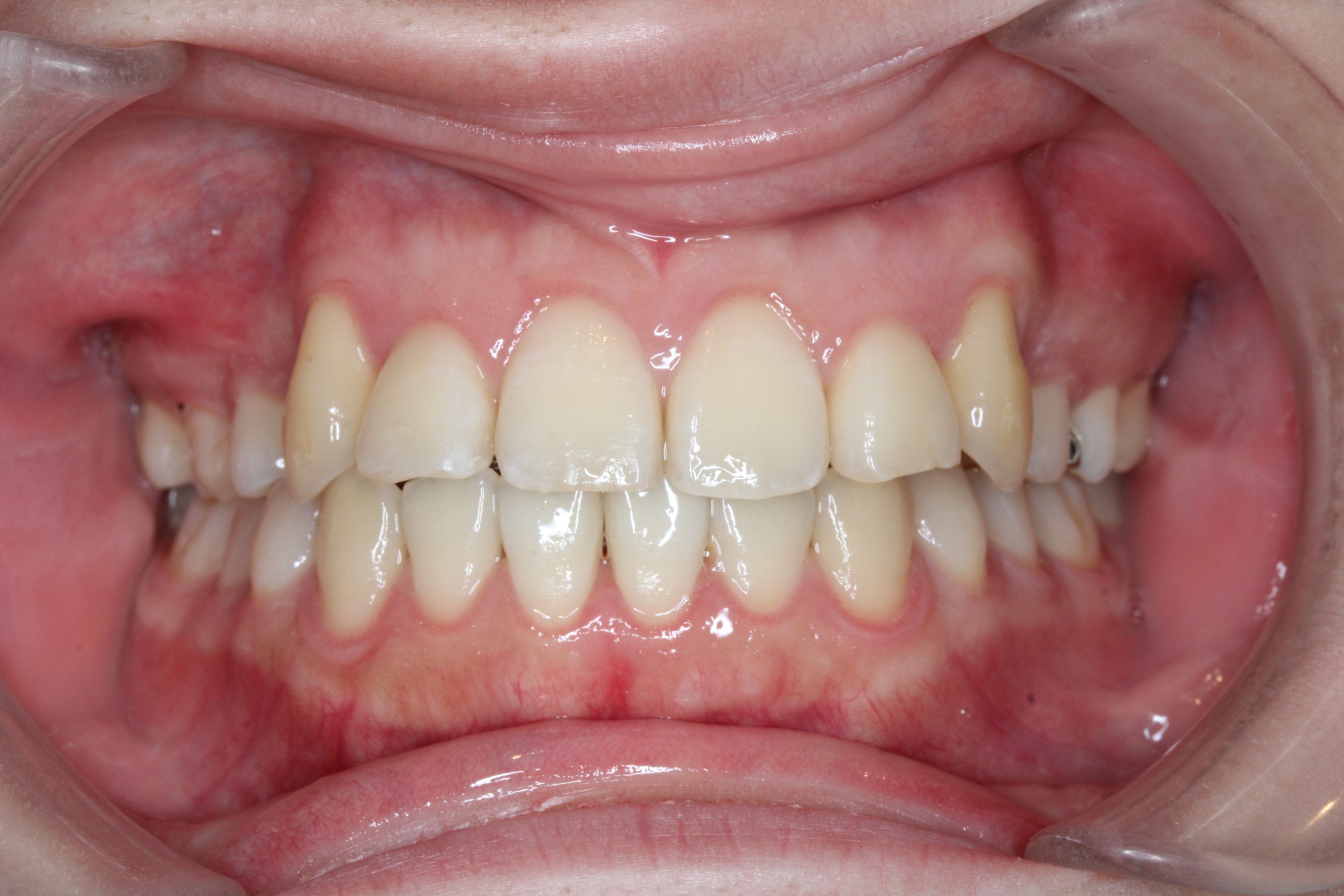 裏側矯正　叢生症例