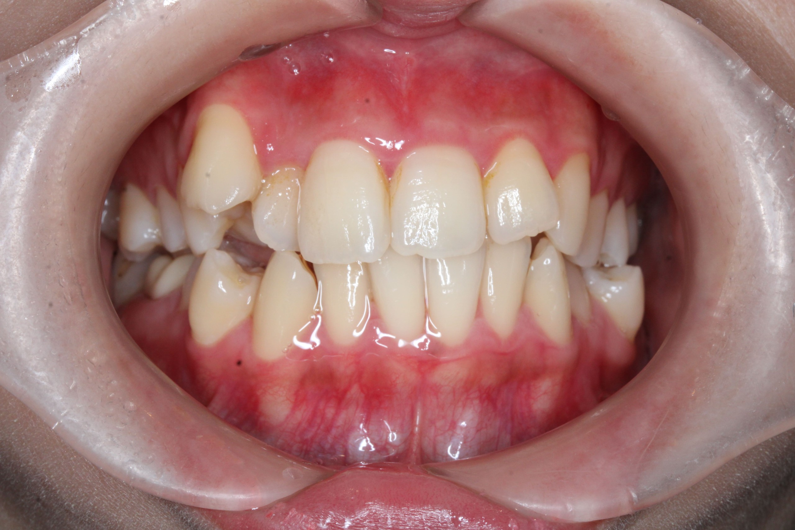 叢生、ハーフリンガルの症例