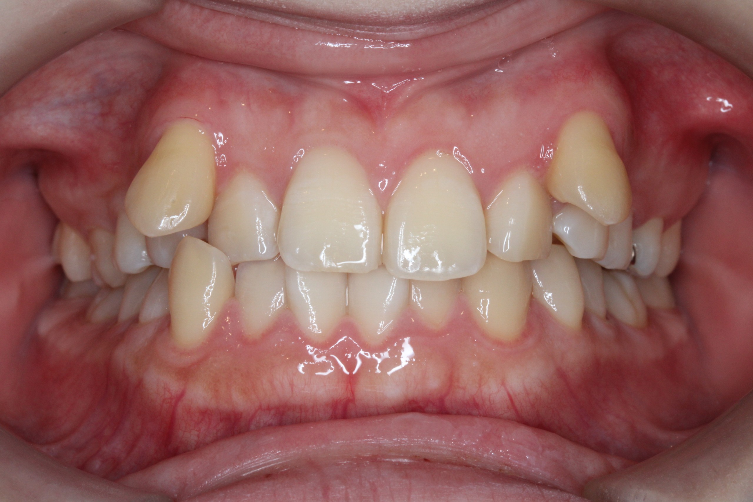 裏側矯正　叢生症例