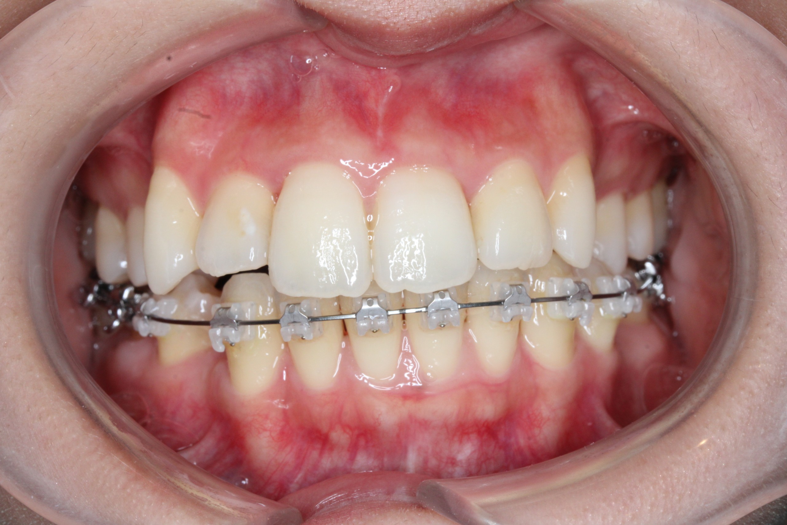 叢生・ハーフリンガルの症例