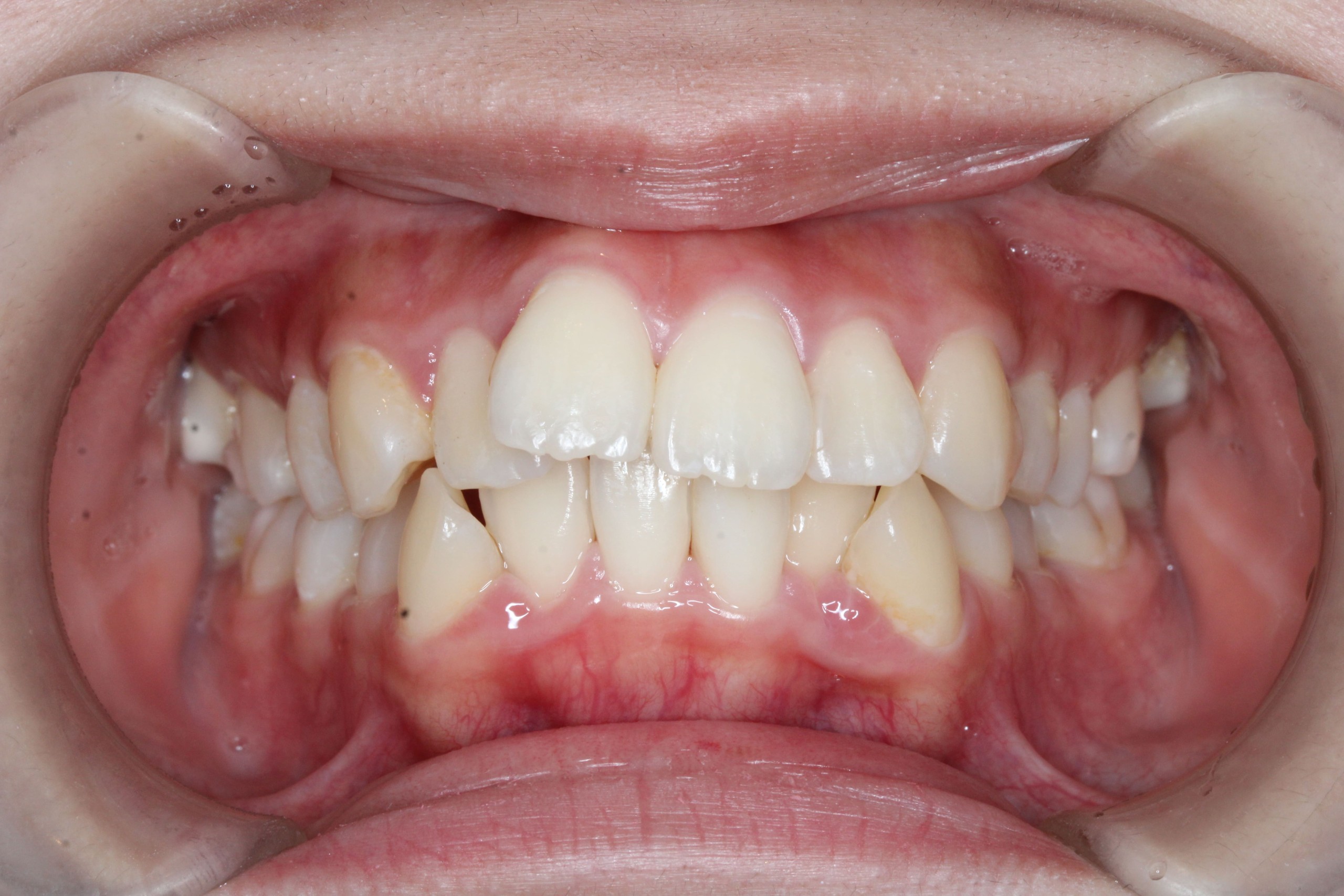 叢生・裏側矯正の症例