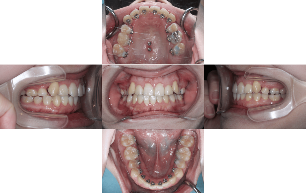 裏側矯正　叢生症例