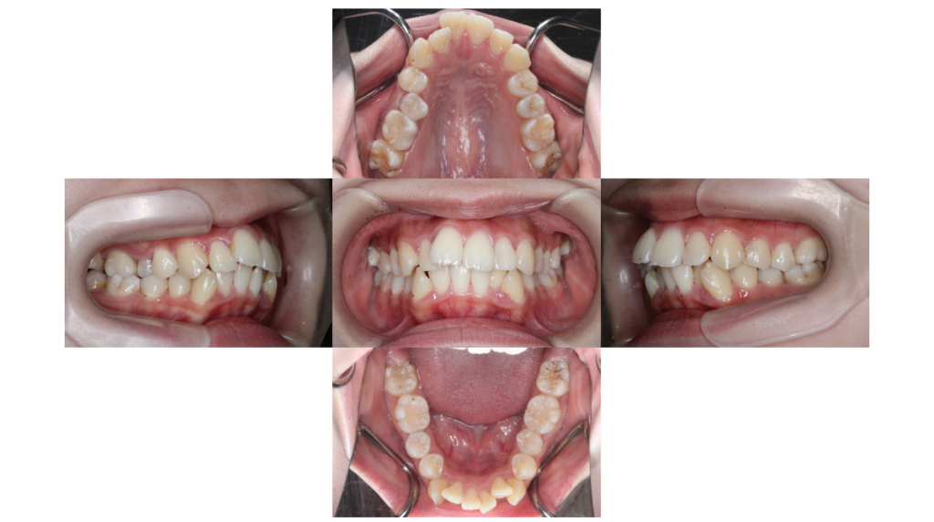 叢生・裏側矯正の症例