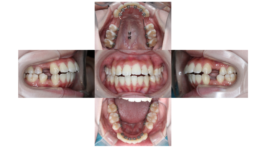 叢生・裏側矯正の症例