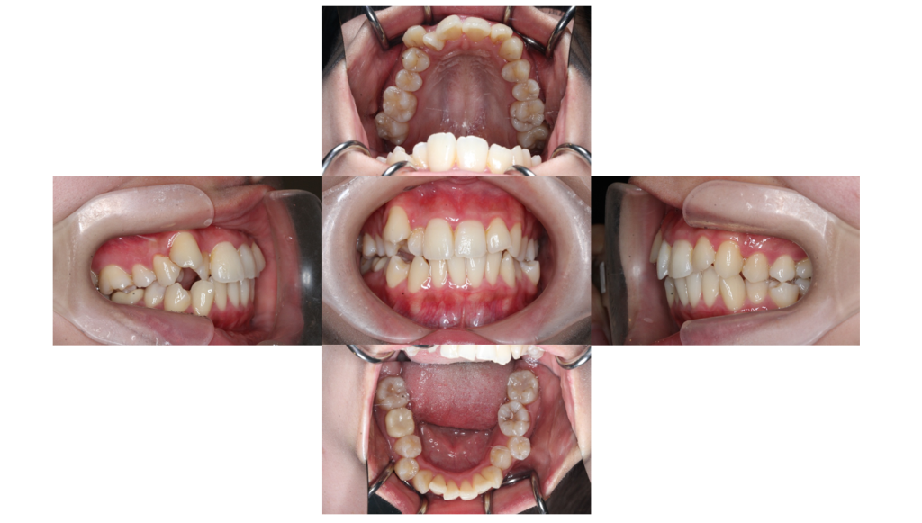 叢生・ハーフリンガルの症例