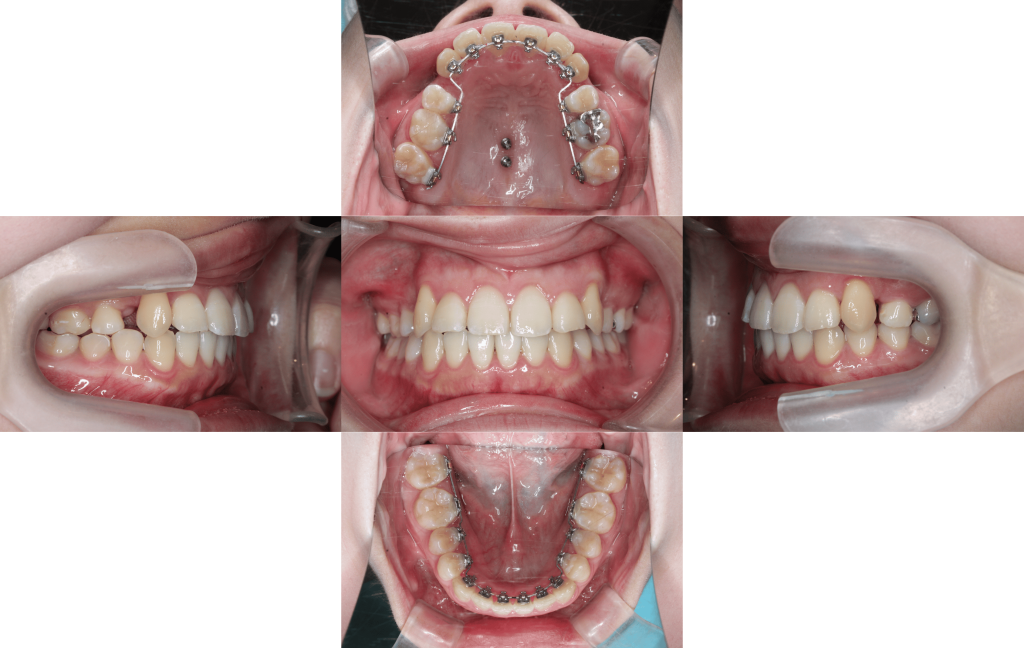 裏側矯正　叢生症例