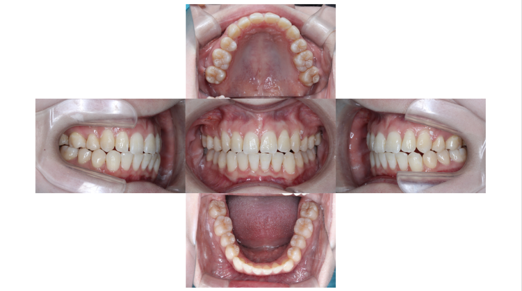 叢生・コンビネーション矯正の症例