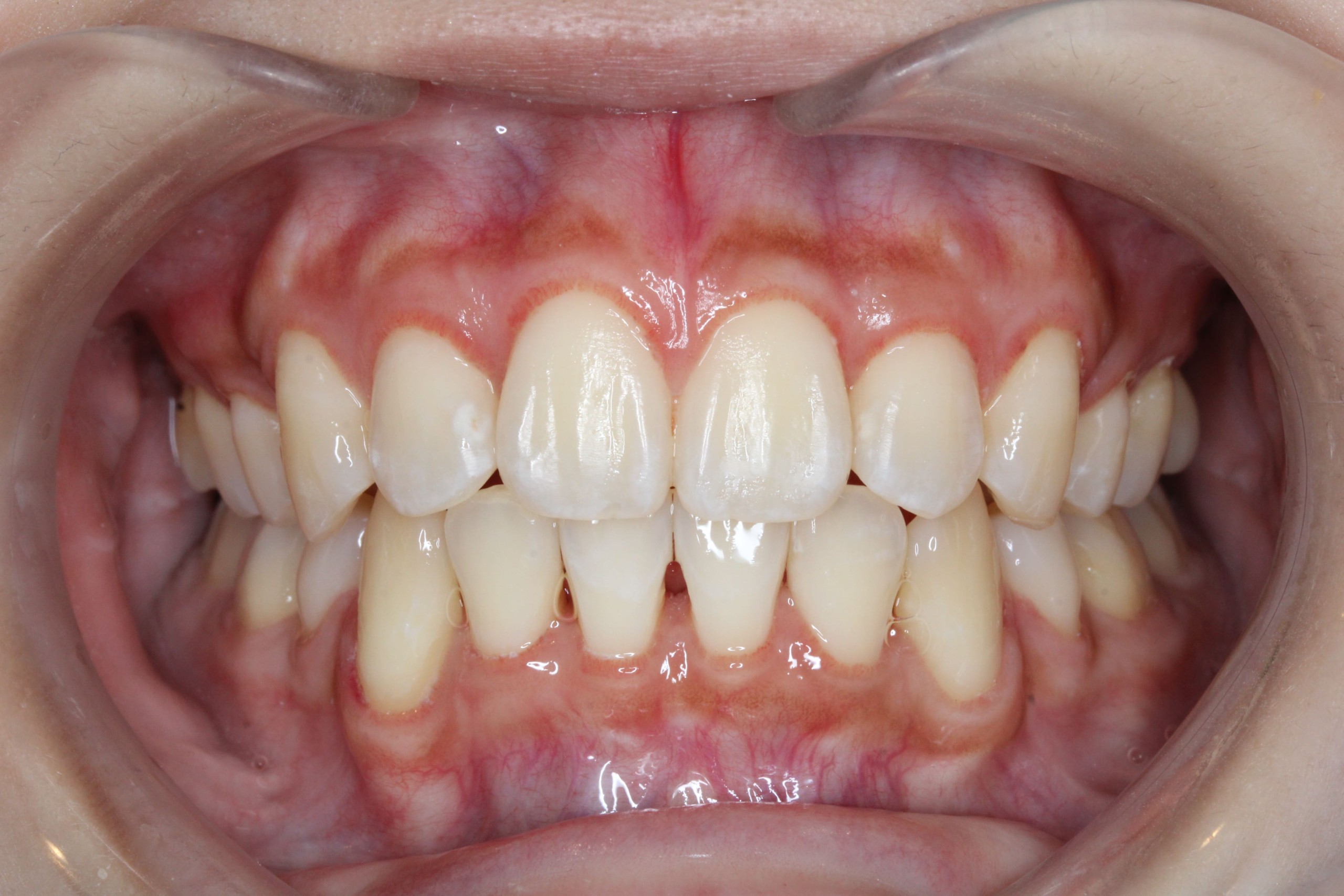 裏側矯正　上顎前突症例