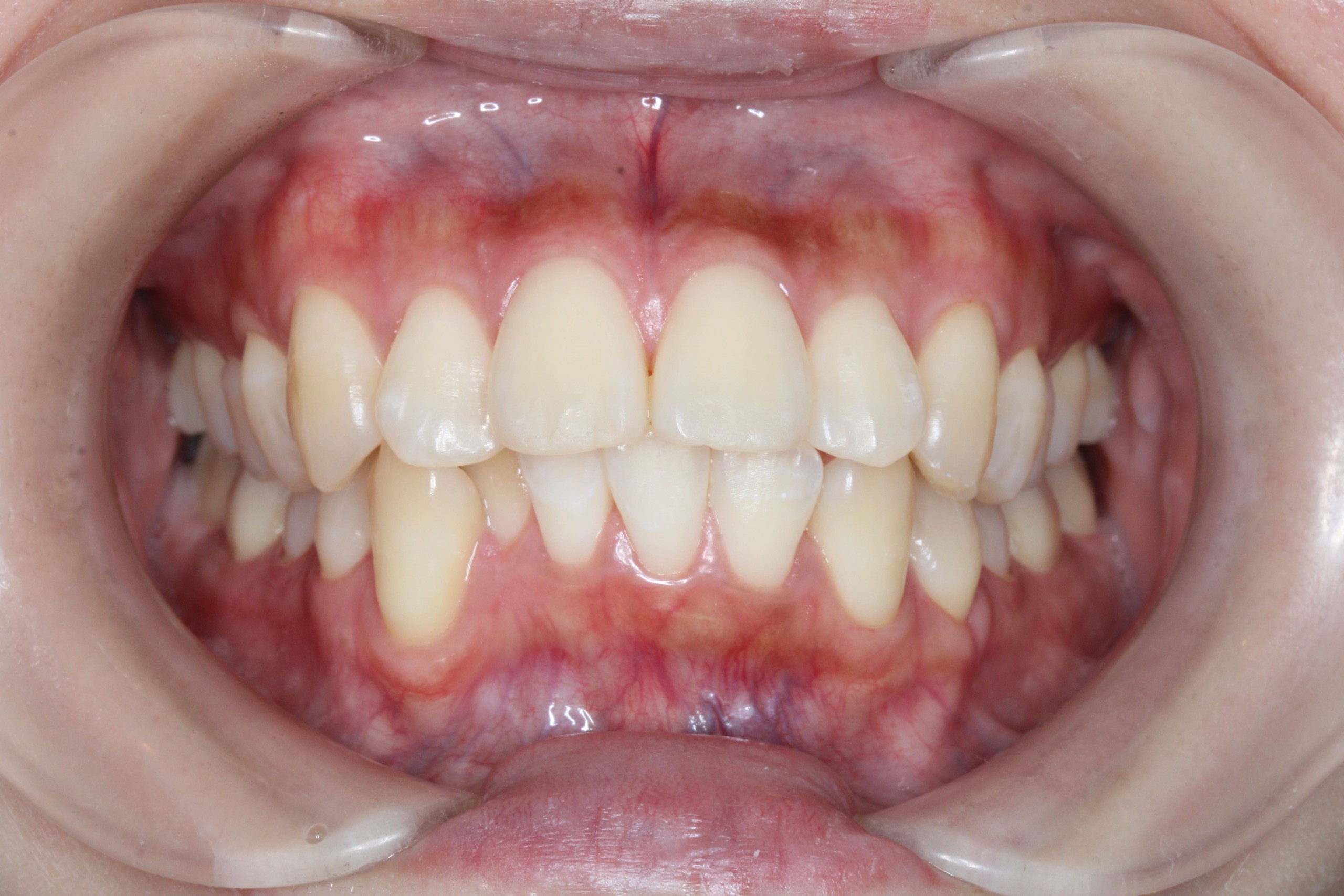 裏側矯正　上顎前突症例