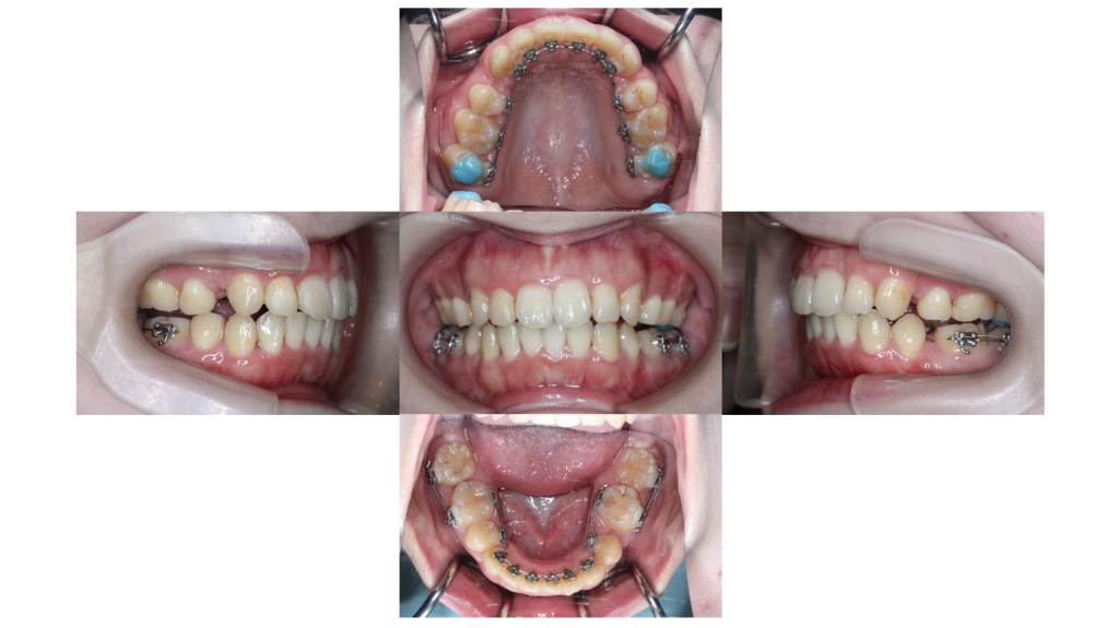 叢生・裏側矯正の症例