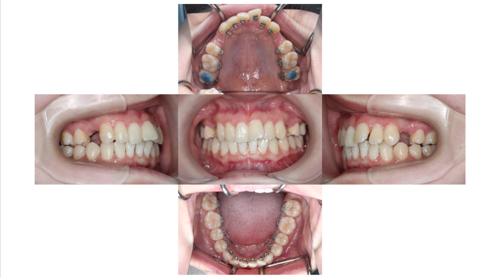 叢生・コンビネーション矯正の症例
