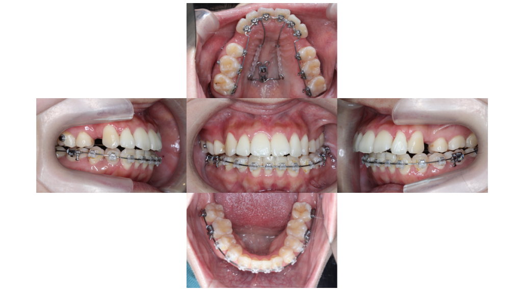 叢生・ハーフリンガルの症例