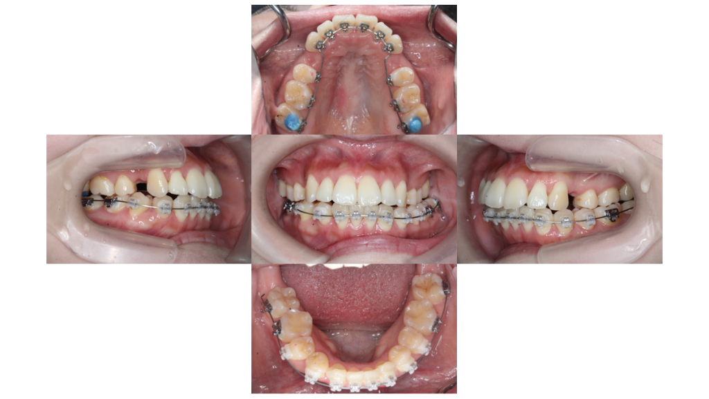 叢生・ハーフリンガルの症例