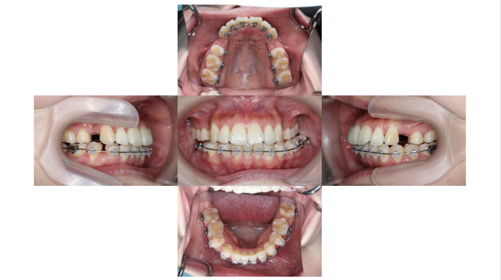 叢生・ハーフリンガルの症例