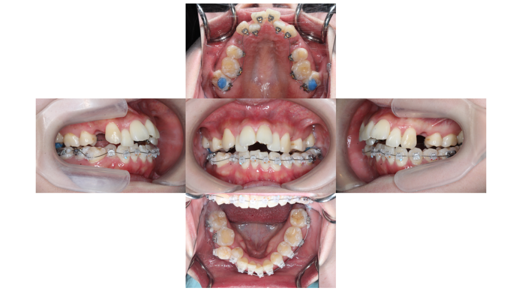 叢生・ハーフリンガルの症例