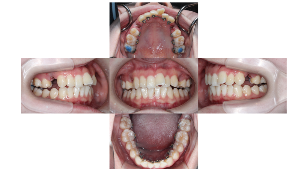 叢生・コンビネーション矯正の症例