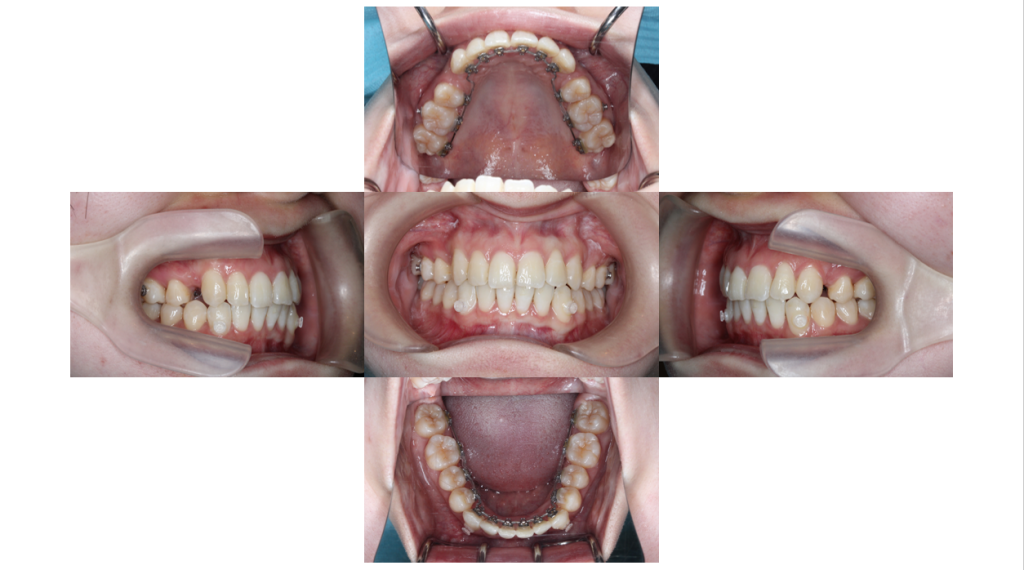 叢生・コンビネーション矯正の症例