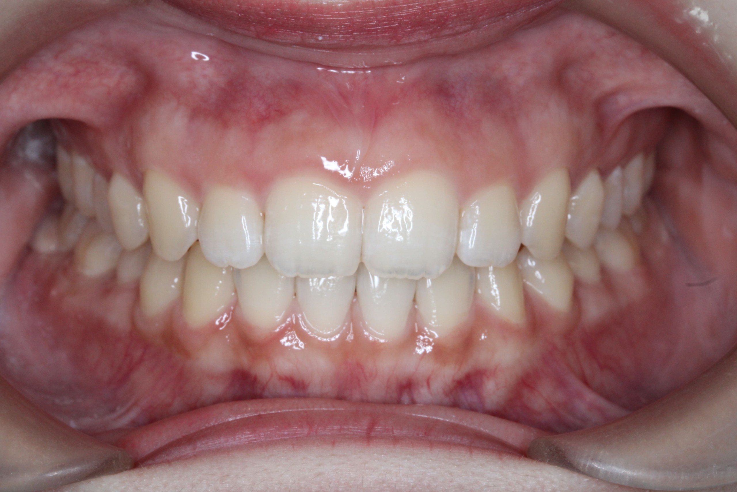 裏側矯正　正中離開症例