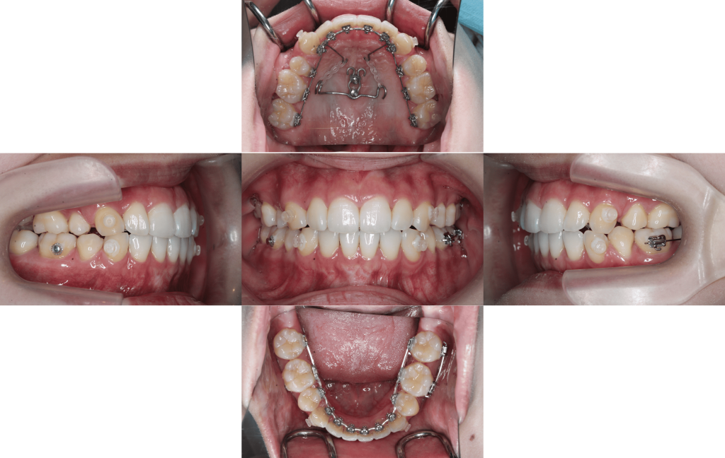 裏側矯正　上下顎前突症例