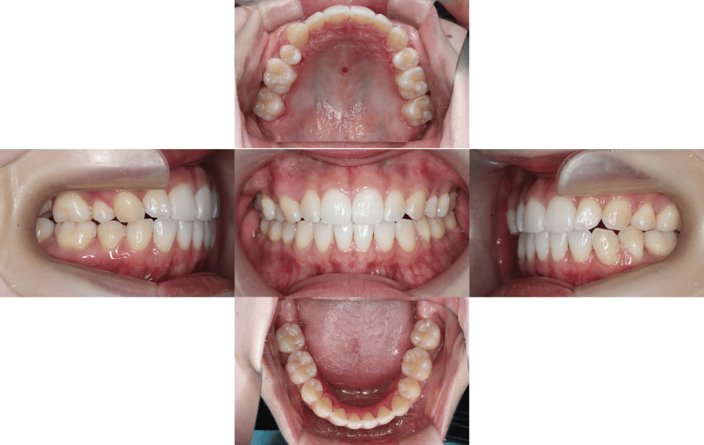 裏側矯正　上下顎前突症例