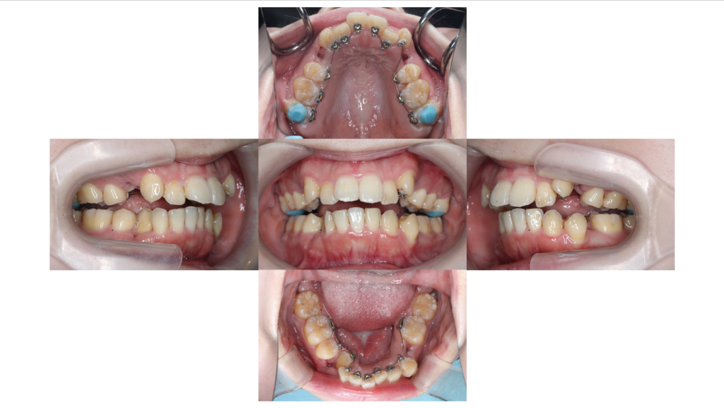 叢生・裏側矯正の症例