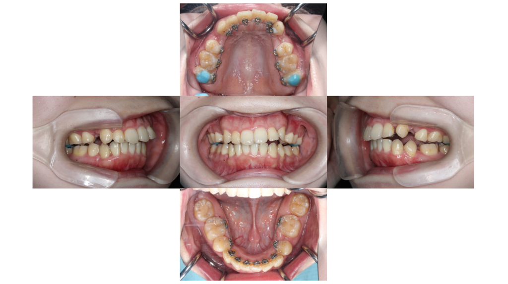 叢生・裏側矯正の症例
