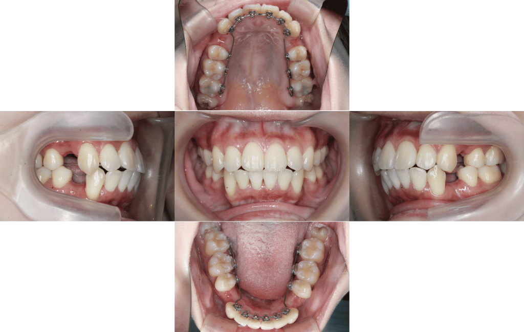 裏側矯正　上顎前突症例
